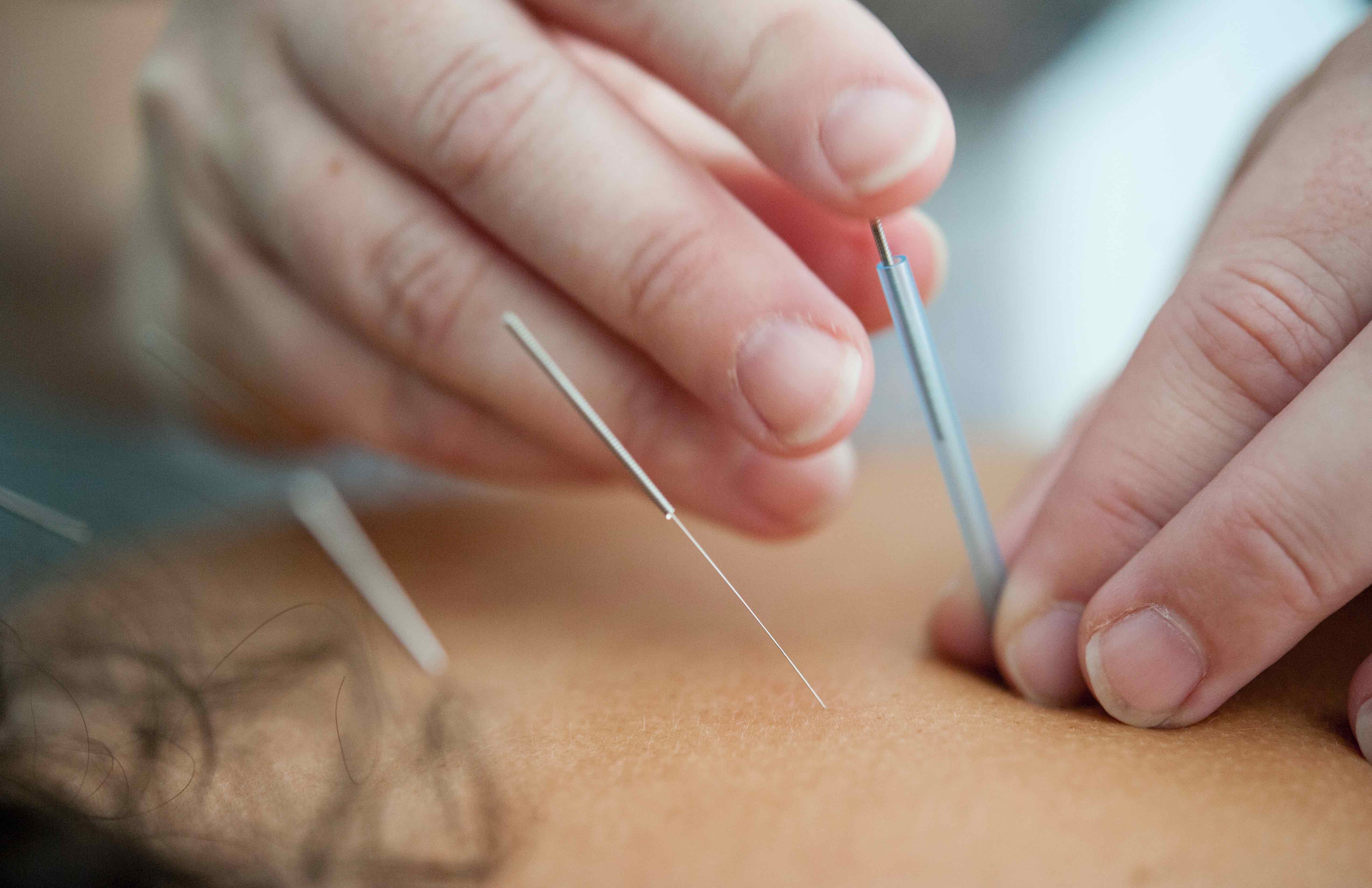 acupuncture is a solution to reduce pain