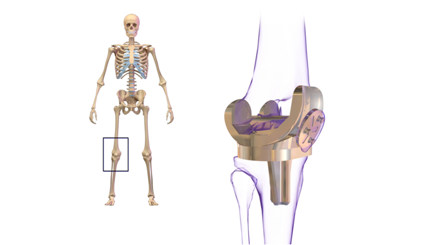 knee replacements may be necessary to regain function.
