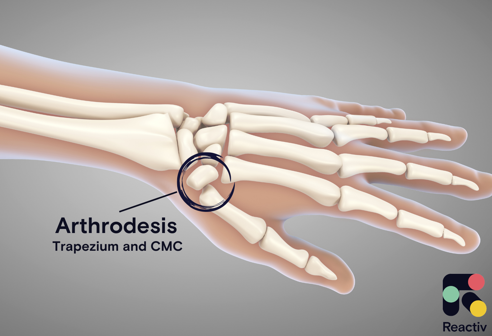 Surgery for thumb arthritis: Arthrodesis