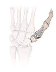 Thumb Arthritis Surgery: Total Joint Arthroplasty